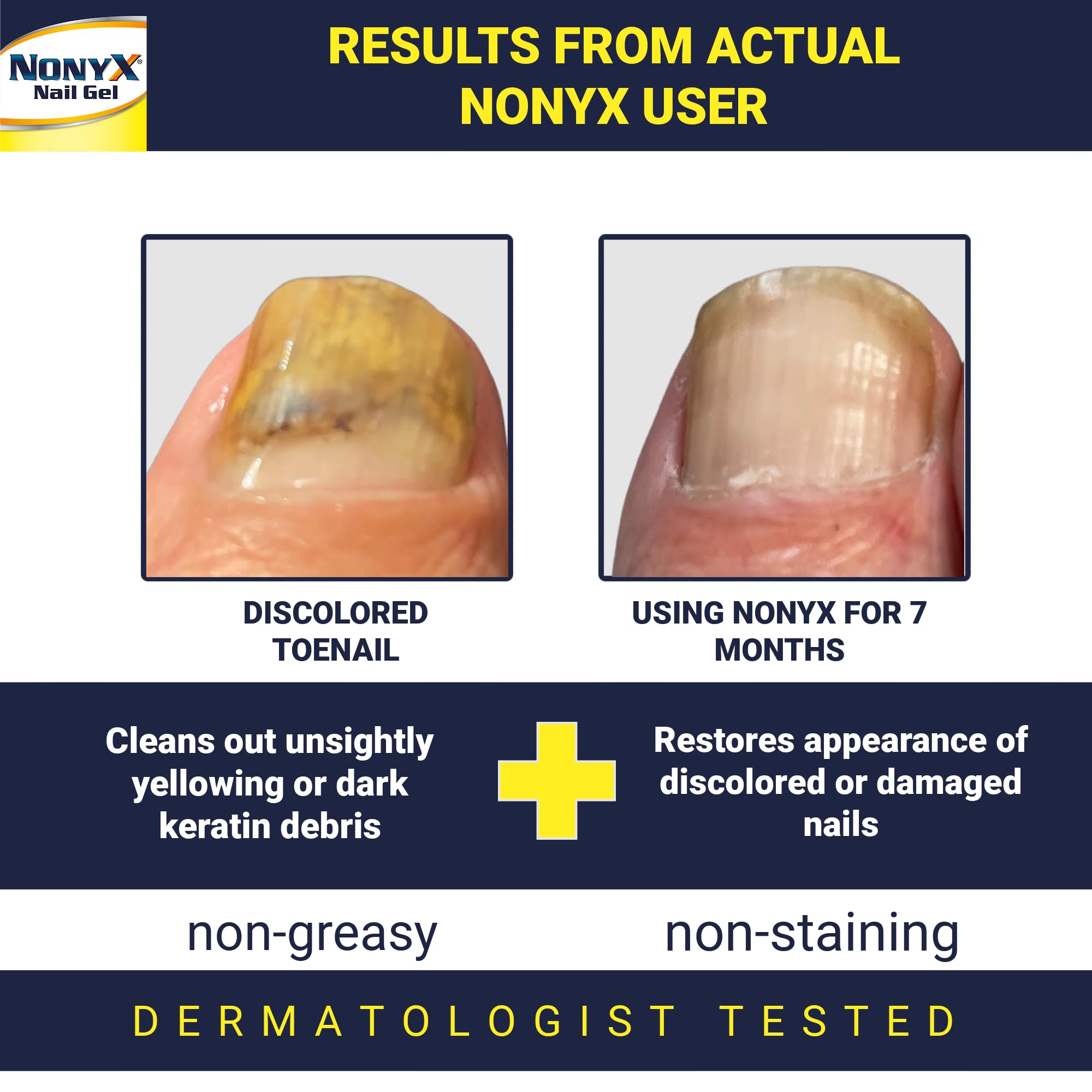 NONYX Fungal Nail Clarifying Gel | Clinically Proven for Discolored, Thick, Brittle, Yellow, Lifted, and other signs of Fungus-Damaged Toenails | 90% of Nails Improve | Over 8 million sold