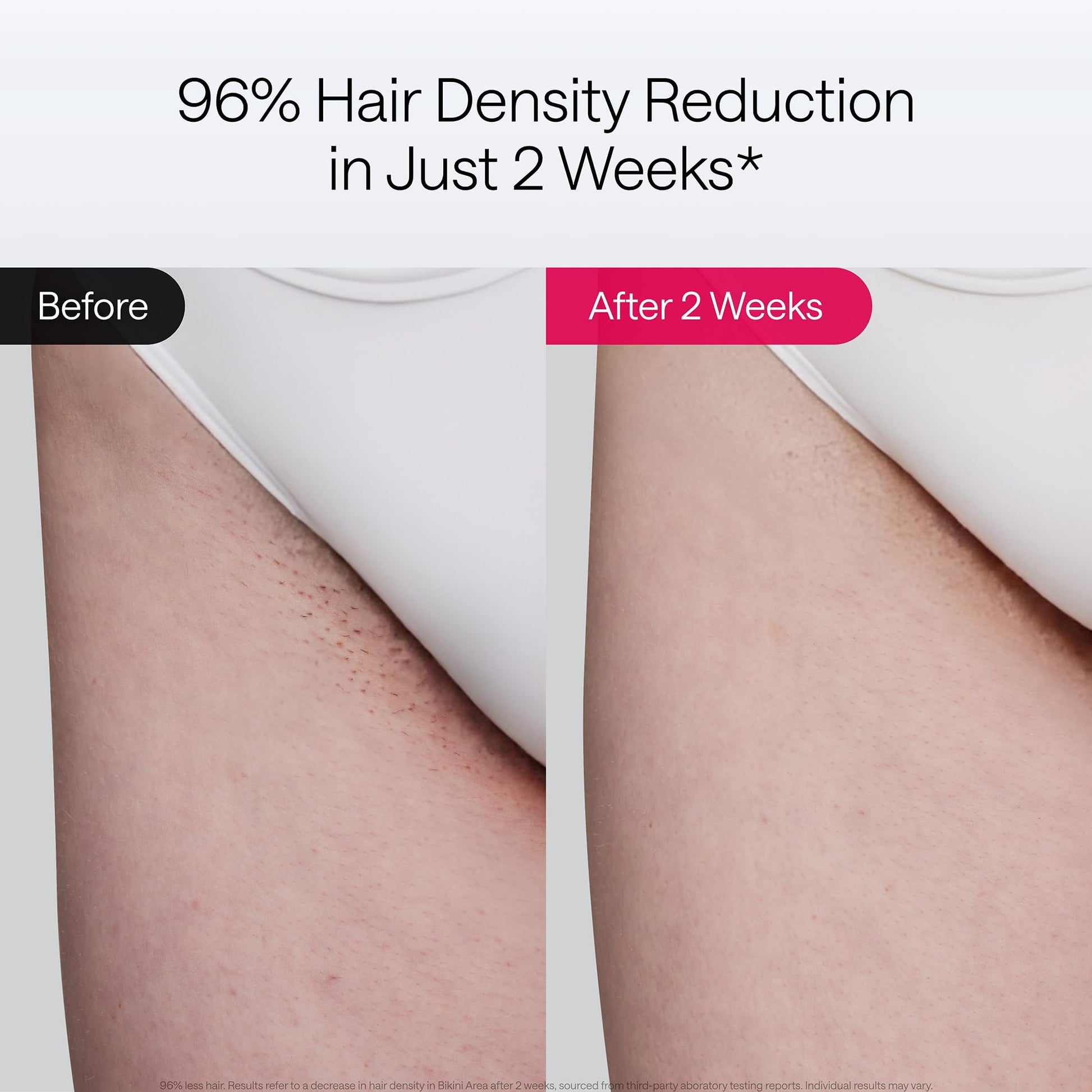 Ulike Laser Hair Removal Device Air 10 Ipl Gift for Women and Men, Ice Cool and Permanent Hair Reduction for Nearly Painless, Dual Lights, Skin Sensor & USHR Mode Hair Removal in 10mins from Home